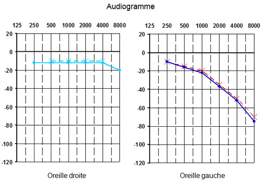 audiogramme-neurinome