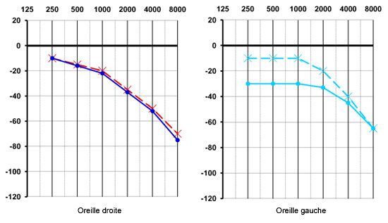 audiogramme2