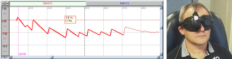 nystagmus-oculaire-trace