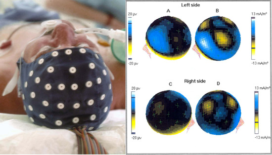 Projections corticales vestibulaires