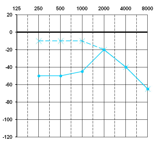 surdite1